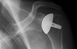 Röntgenbild mit Schulterprothese, Orthopädie der Uniklinik Rostock