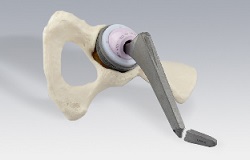 Implantat mit Stilbruch in der Orthopädie der Uniklinik Rostock