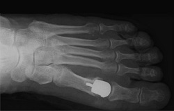 Röntgenbild mit Prothese in Fussgelenkin der  Orthopädie der Uniklinik Rostock