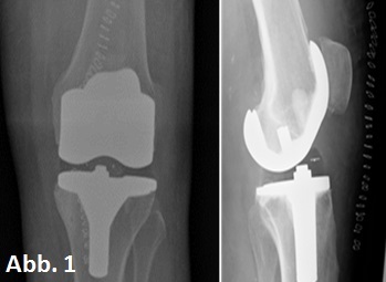 zwei Röntgenaufnahmen von einem Gelenk in der Orthopädie der Uniklinik Rostock