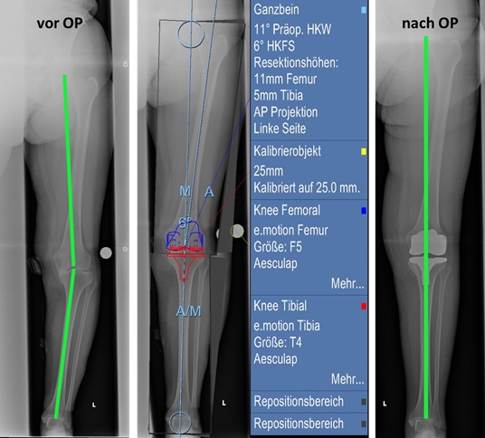 drei Röntgenaufnahmen von einem Gelenk in der Orthopädie der Uniklinik Rostock