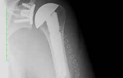 Röntgenbild mit Schultergelenkersatz vor weißem Hintergrund, Orthopädie der Uniklinik Rostock
