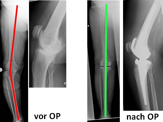 RöntgenBilder von Bein mit und ohne Prothese, Orthopädie der Uniklinik Rostock