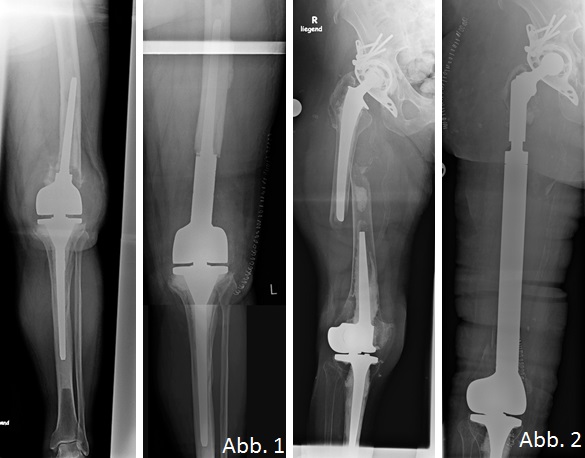 Röntgenbild Bein mit Prothesen in der Orthopädie der Uniklinik Rostock