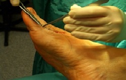 Nahaufnahme Fuß mit Chirurgenhände, die Schnitt setzen in Arzt mit Bart, Sportorthopäde der Uniklinik Rostock