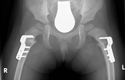 Röntgenbild Babyhüften mit zwei Gelenkprothesen