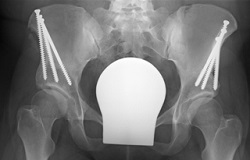 Röntgenbild Hüfte mit weißen Stäben 