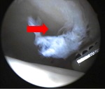 schwarzer Kreis mit Röntgenbild von einem Gelenk mit rotem Pfeil in der Orthopädie der Uniklinik Rostock