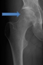 Röntgenbild von Hüfte mit blauem Pfeil in der Orthopädie der Uniklinik Rostock