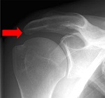 Röntgenbild Schultergelenk mit rotem Pfeil in der Orthopädie der Uniklinik Rostock