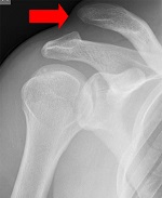 Röntgenbild Schulter mit rotem Pfeil in der Orthopädie der Uniklinik Rostock