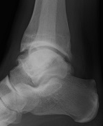 Röntgenaufnahme Fußgelenk in der Orthopädie der Uniklinik Rostock