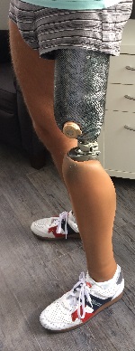 Mann mit Beinprothese in der Orthopädie der Uniklinik Rostock