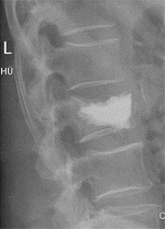 Röntgenbild von einem Wirbelbruch in der Orthopädie der Uniklinik Rostock