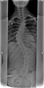 Röntgenbild einer verkrümmten Wirbelsäule in der Orthopädie der Uniklinik Rostock