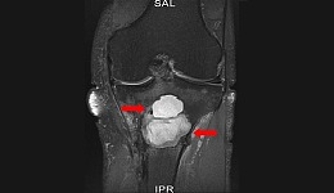 Röntgenbild von einem Knochentumor