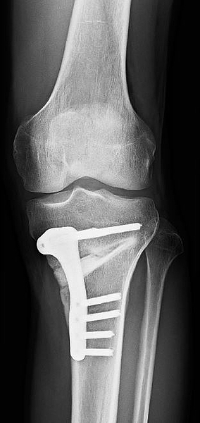 Röntgenbild Knochen mit Prothese in der Orthopädie der Uniklinik Rostock